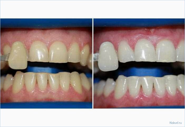Отбеливание зубов Zoom 4: отзывы и результаты