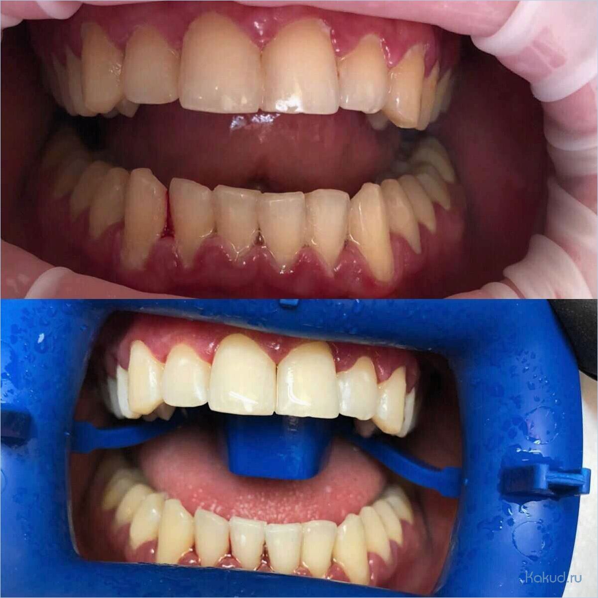 Отбеливание зубов Zoom 4: отзывы и результаты