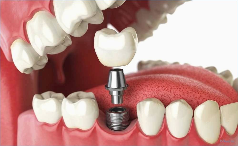 Имплантация зубов: все, что нужно знать