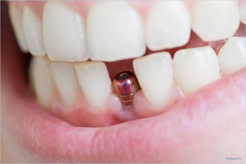 Имплантация зубов: все, что нужно знать