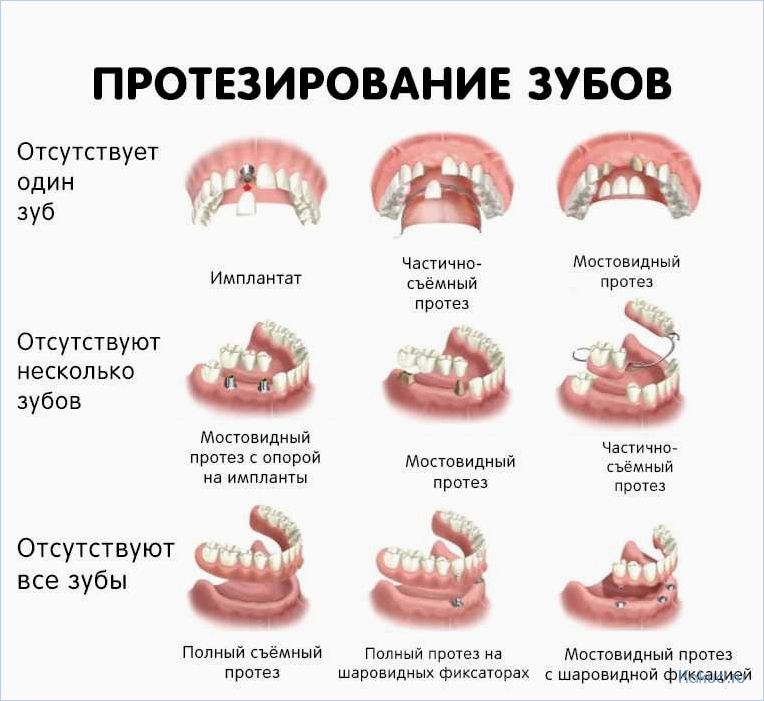Все, что нужно знать о зубных протезах: виды, уход и преимущества