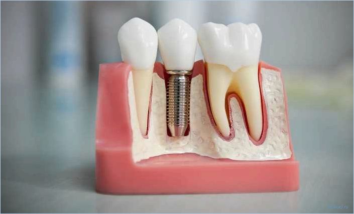 Все, что нужно знать о зубных протезах: виды, уход и преимущества