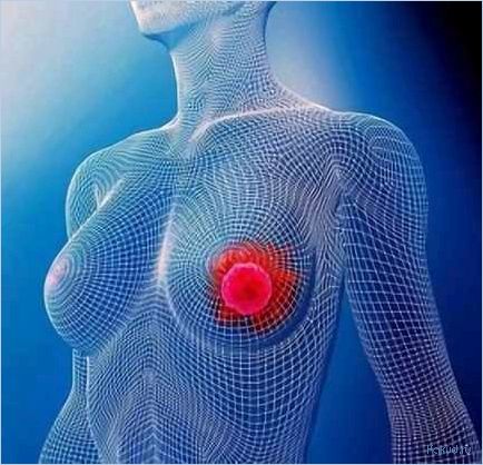 Лечение рака груди в Германии — инновационные методы диагностики и терапии, высокий уровень медицинской помощи
