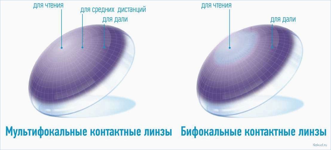 Преимущества и особенности торических контактных линз